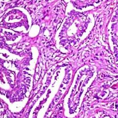 Imatge al microscopi de càncer de còlon.