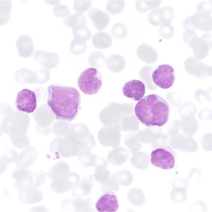 Exemple de leucèmia limfoblàstica aguda de tipus T (cèl·lules canceroses tenyides de lila).