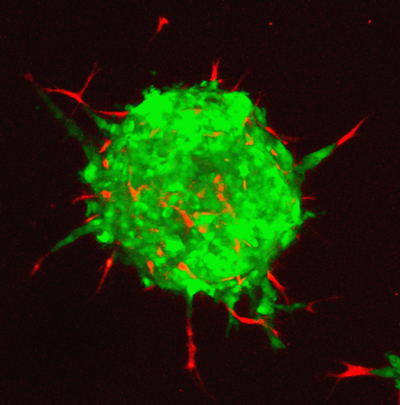Els investigadors han descobert que les cèl·lules canceroses utilitzen la mobilitat dels fibroblasts per escapar dels tumors i desplaçar-se pels teixits. 