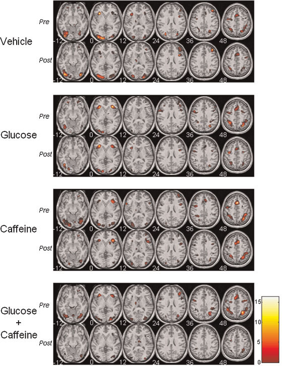 El contrast mostra les àrees amb una activitat cerebral significant.