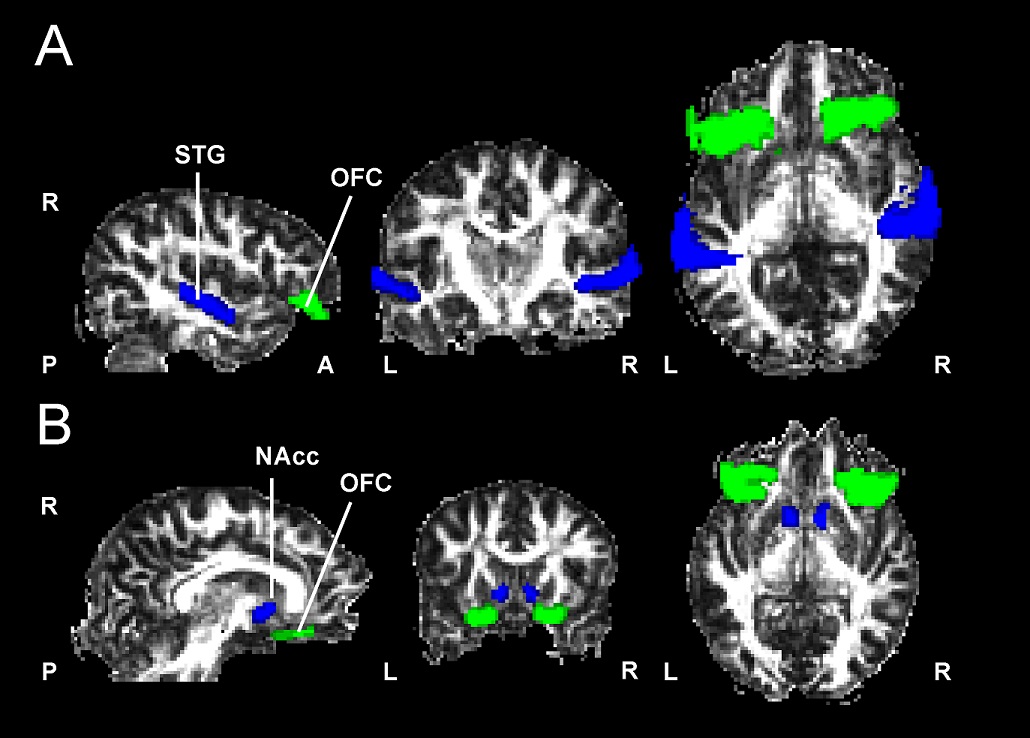 L'estudi de la UB i l’IDIBELL mostra que les connexions de la substància blanca del cervell són clau per entendre per què ens agrada o no la música. 