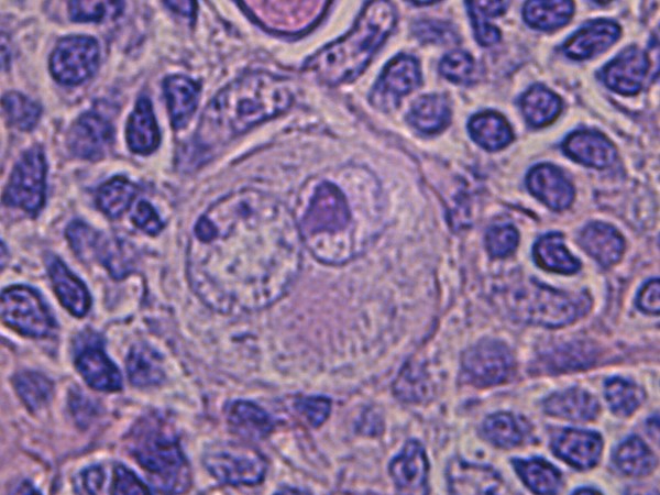 Imatge al microscopi òptic d’un limfoma de Hodgkin. Just al centre s’hi aprecia la característica formació arrodonida denominada <i>cèl·lula de Reed-Sternberg</i>.