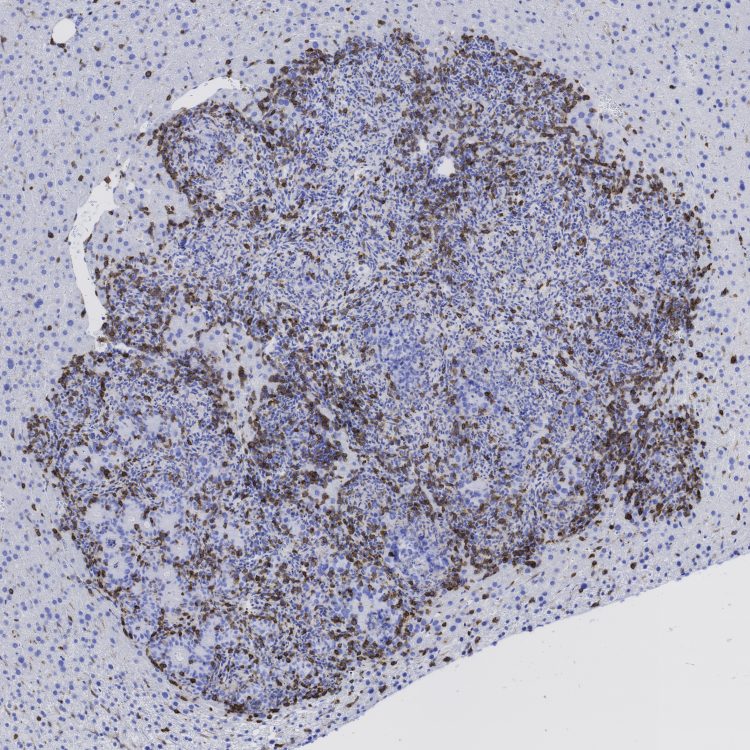 Tumor metastàtic de còlon infiltrat pel sistema immune (en marró) després de la combinació de l'inhibidor de TGF-beta i immunoteràpia. Foto: Daniele Tauriello, IRB Barcelona
