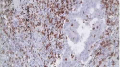 Visió microscòpica d’un pulmó afectat de càncer en el qual les cèl·lules immunes (color marró) s’infiltren entre les cèl·lules tumorals (color blau). 
